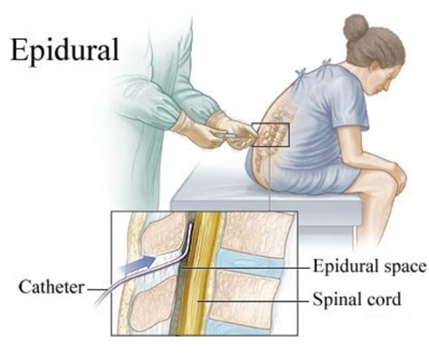EPIDURAL Definition & Meaning .